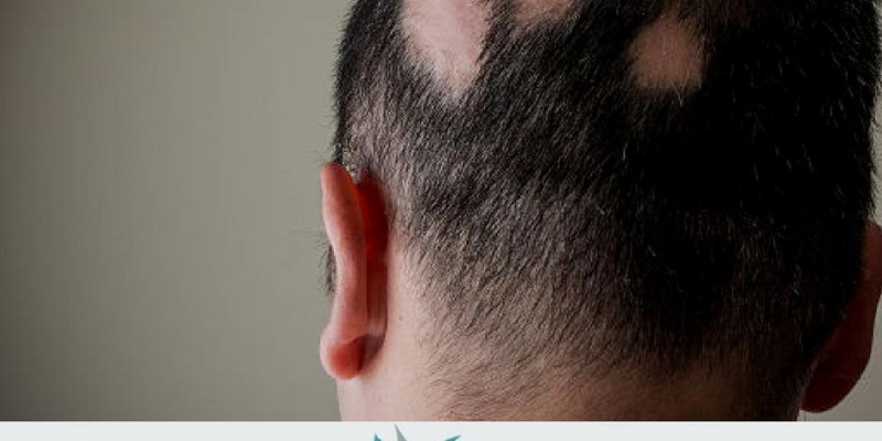 O que é ALOPECIA AREATA?