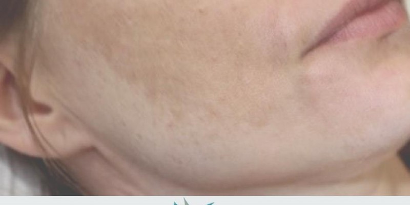 Melasma - CAUSAS E PREVENÇÃO